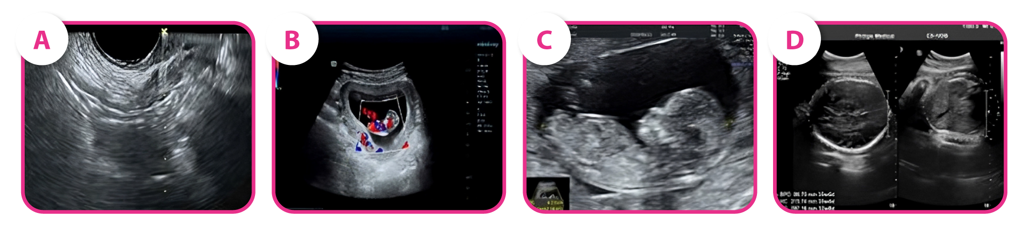 Gravidez e desfechos neonatais. (B-D) Ultrassom de uma paciente gestante na semana 8 (B), 13 (C) e 32 (D).